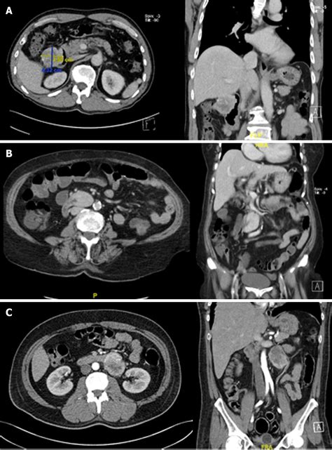 Current Surgical Management Of Duodenal Gastrointestinal Stromal Tumors