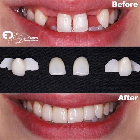 A before and after with our Emax Crowns | Elegant Lab