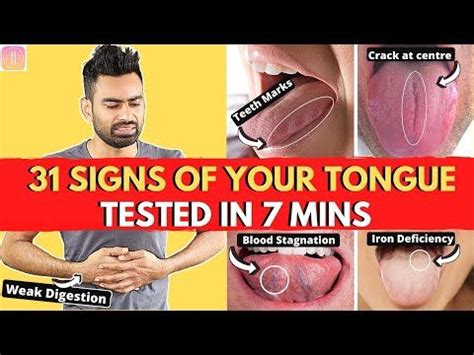 How To Heal A Sore Tongue 13 Steps With Pictures Artofit