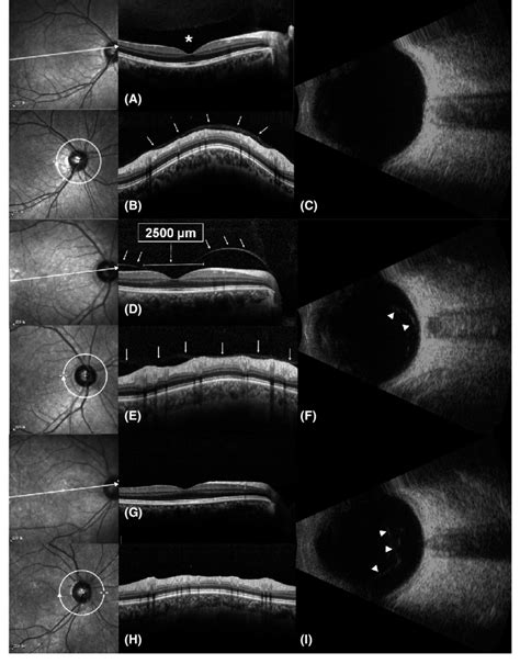 Posterior Vitreous Detachment Vision