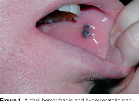 Thrombocytopenic Purpura