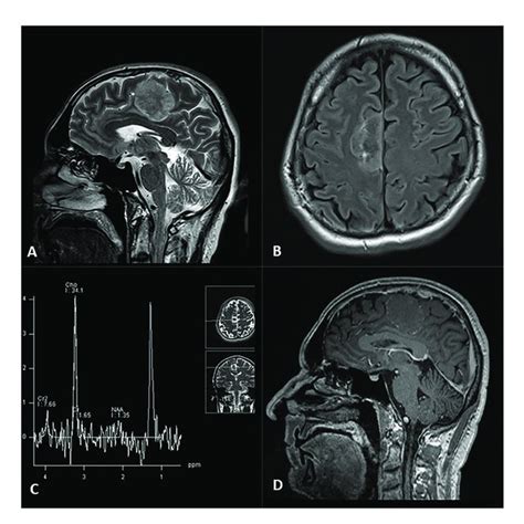 Right Frontal Parafalcine Tumor Evident On T2 Sagittal A And Flair Download Scientific