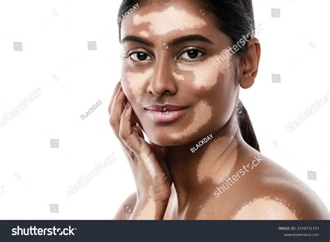 Vitiligo Models Images: Browse 2,022 Stock Photos & Vectors Free Download with Trial | Shutterstock