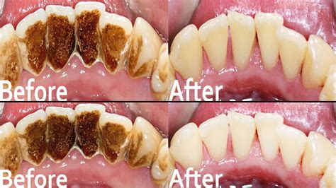 Tartar Vs Plaque How To Remove Plaque From Teeth Remove Dental