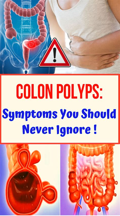 Colon Polyps: Symptoms You Should Never Ignore - wellness magazine