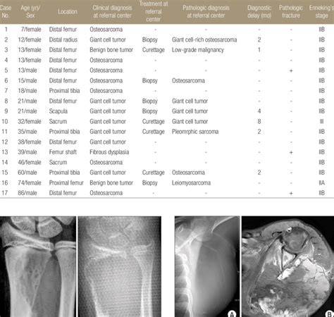 Demographics And Clinical Data Of 17 Cases Of Giant Cell Rich