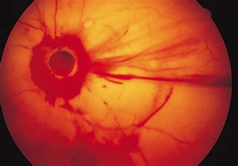 Avulsion Of The Optic Nerve Head After Orbital Trauma Jama