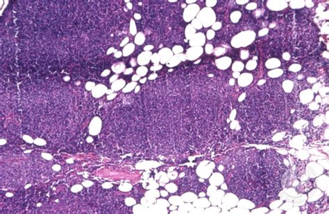 Follicular Lymphoma - 5.