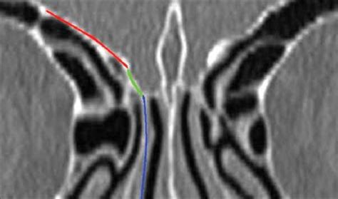 Ethmoid Roof Anatomy Figure 6 Cbct Coronal View