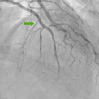 Coronary angiogram and PCI. Post PCI and stent insertion (green arrow ...