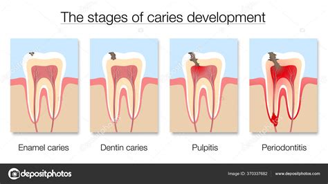 Tabla Etapas Caries Desarrollo Caries Dental Con Esmalte Caries Dental