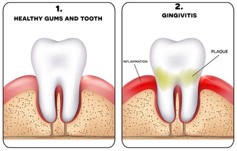 6 Signs You Need To See A Periodontist Asap Md Periodontics