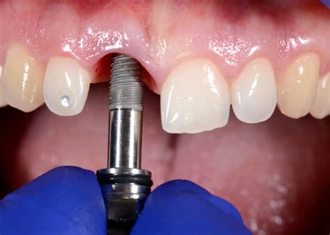 Unveiling The Dental Implant Healing Stages A Step By Step Journey