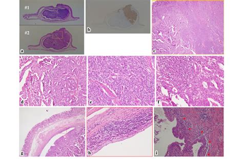 Figure Histological Findings Of The Resected Specimen A The Tumor