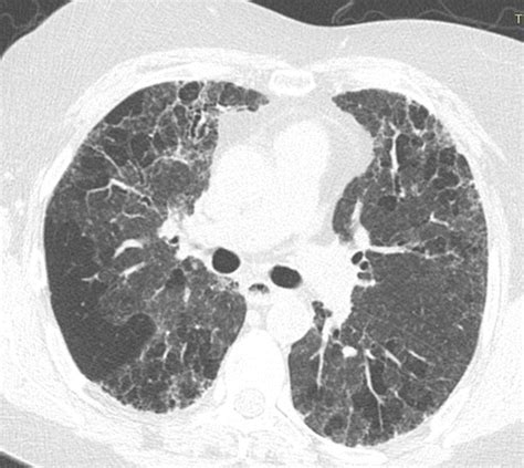 Lung Fibrosis Ct Scan | SexiezPicz Web Porn