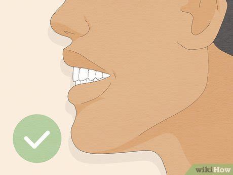 7 Ways to Fix an Overbite - wikiHow