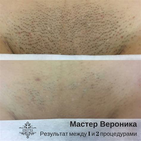 Лазерная эпиляция стоимость бикини: Лазерная эпиляция бикини (глубокое ...