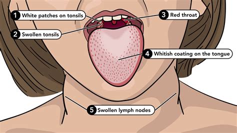 Symptoms of Scarlet Fever | Group A Strep | CDC