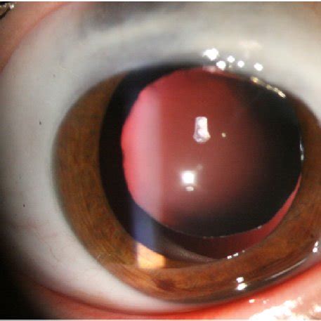 Note the malar hypoplasia and downward slanting of the palpebral ...