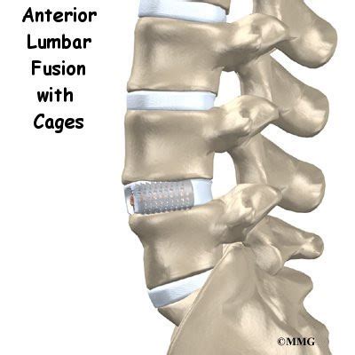 Anterior Lumbar Fusion with Cages - Orthogate