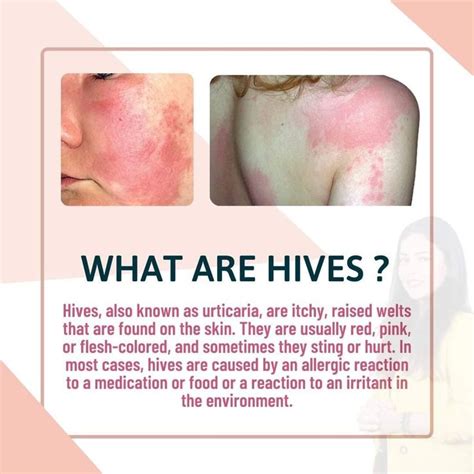 Hives Also Known As Urticaria Are Itchy Raised Welts That Are Found