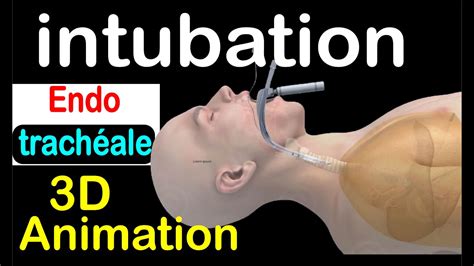 Réanimation l intubation endotrachéale 3D animation YouTube