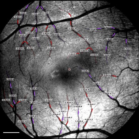 Retinal Microvascular Network And Microcirculation Assessments In High