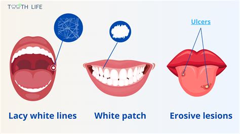 Oral lichen planus: A Mysterious Mouth Condition