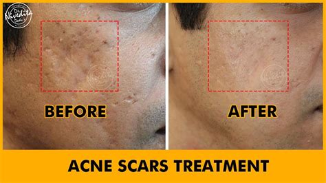 Patient Testimonial Acne Scars Treatment Dr Nivedita Dadus