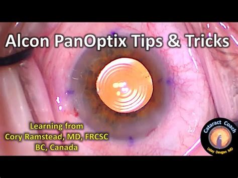 Alcon PanOptix Trifocal IOL Tips Tricks For Cataract, 58% OFF