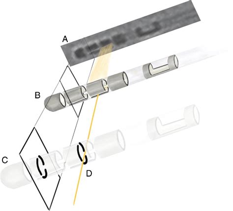 Figure 1 From Determining The Orientation Of Directional Deep Brain Stimulation Electrodes Using