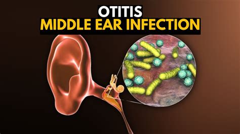 Middle Ear Infection Otitis Media Causes SIgns And Symptoms