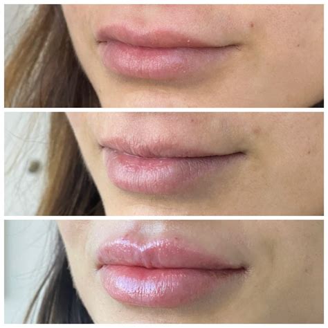 Before And Afters Of Lip Filler Botox Sculptra And Laser In Colorado