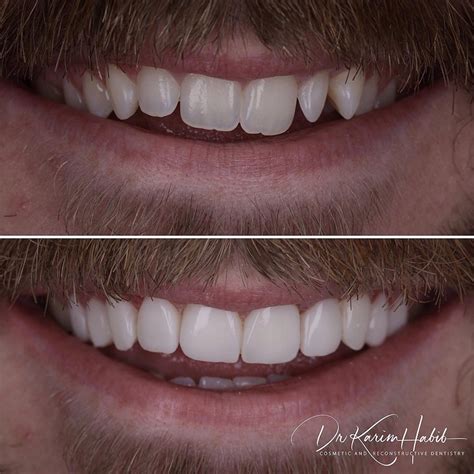 Composite Veneers Sydney Dental Bonding Sydney Dentist Ryde