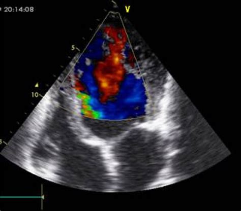 Vista De 4 Cámaras Con Doppler Color Por Ecocardiografía 2d Paciente