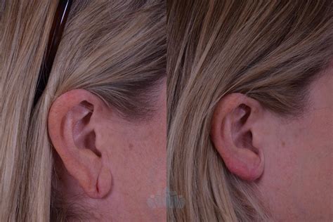 Earlobe Repair Before And After Pictures Case Charlotte Nc