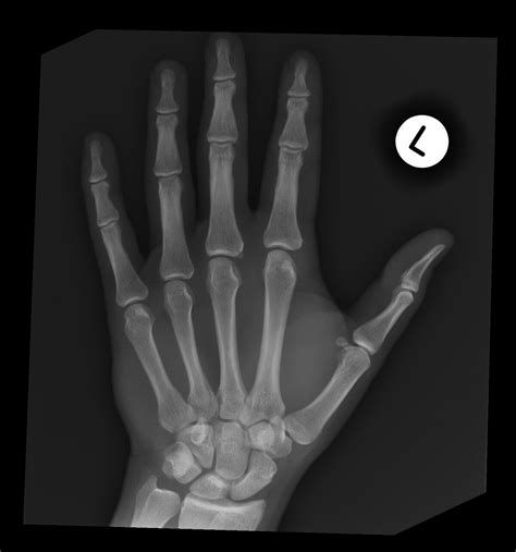 Radiopaedia Case Old Avulsion Fracture At Metacarpophalangeal Joint Id