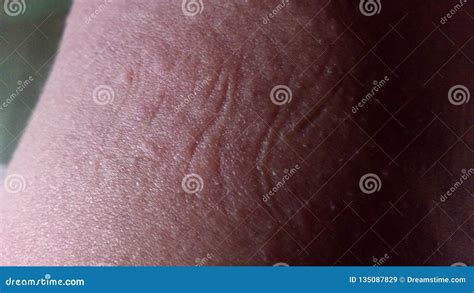 Skin rashes stock image. Image of common, skin, rash - 135087829