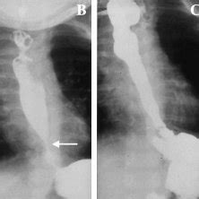 Case 2. A. Initial esophagram at 14 days of age showed a tapered... | Download Scientific Diagram