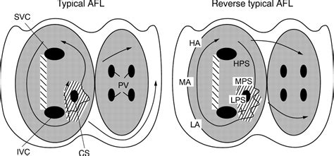 Treatment Of Atrial Flutter Heart