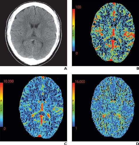 Figure From Imaging Of Stroke Part Perfusion Ct Overview Of