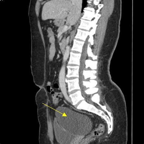 Sagittal View Of Left Adnexal Cyst Yellow Arrow On Ct Abdomen And