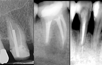 Broken Instruments Clinical Decision Making Algorithm American