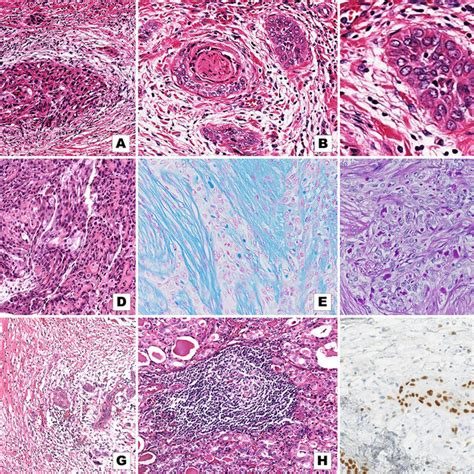 Histopathologic Findings Of Case Mec A Low Power Field Shows Nests