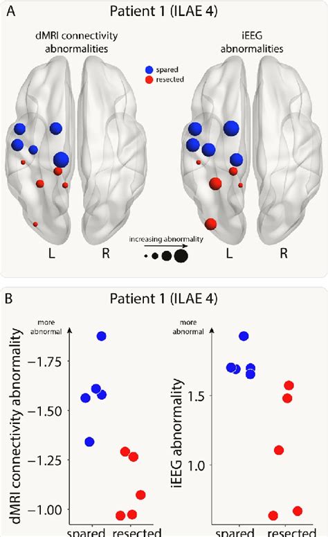 Connectivity And IEEG Abnormalities In An Example Patient A The Brain