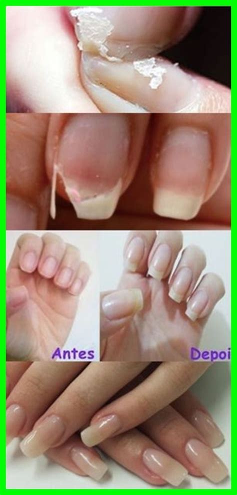 Rem Dios Caseiros Para Unhas Quebradi As Unhas Quebradi As Unhas