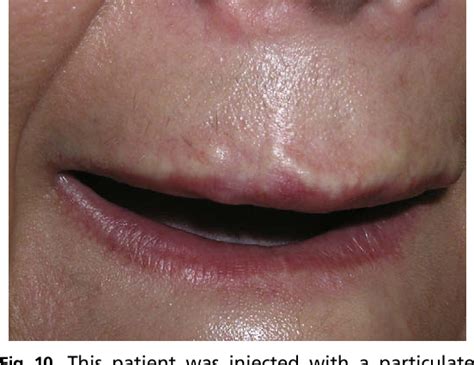 Figure 2 From Complications In Fillers And Botox Semantic Scholar