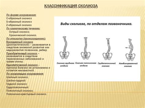 Сколиоз. Как с ним бороться? - презентация онлайн