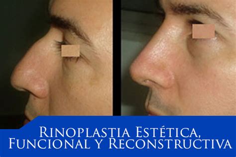 Rinoplastia Estética Funcional y Reconstructiva Ricardo Jaraba M D ORL