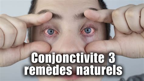 Conjonctivite Rem Des Naturels Pour Soulager Vos Yeux Youtube